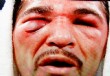 A Margarito le sali� un   ojo de la cara
